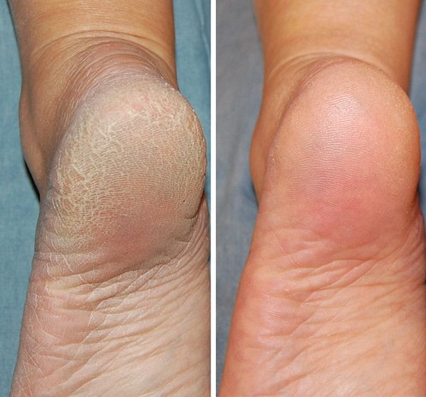 Lixa Removedora de Calos Profissional - Compre 1 Leve 2